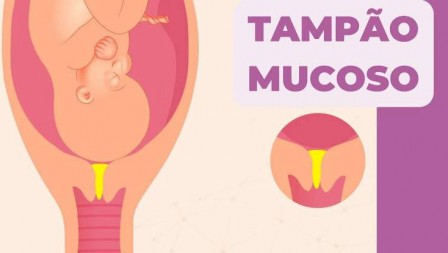 Perda do tampão mucoso: Obstetra do HMSI explica o que fazer